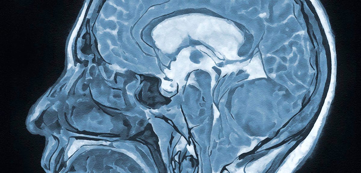 Hypnose bei Hirnoperationen: Einblicke und Vorteile